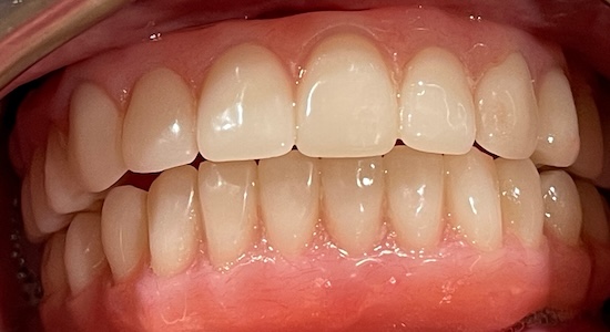 All-on-6 Implants after