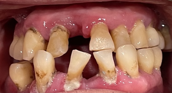 All-on-6 Implants before