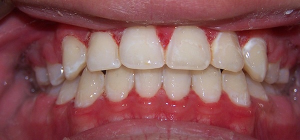 Braces 1 after