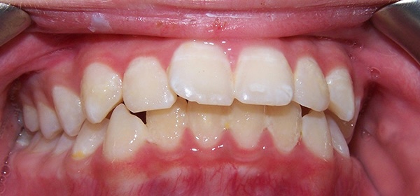 Braces 1 before