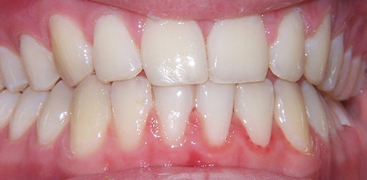 Braces 2 after