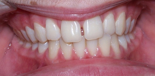 Braces 2 before