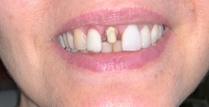 Crown before