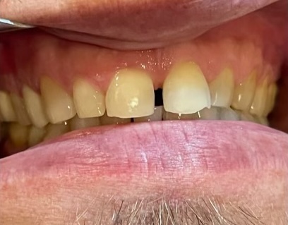Veneers 3 before