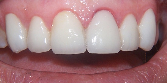 Veneers 2 after