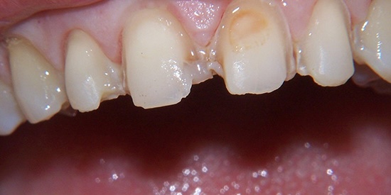 Veneers 2 before