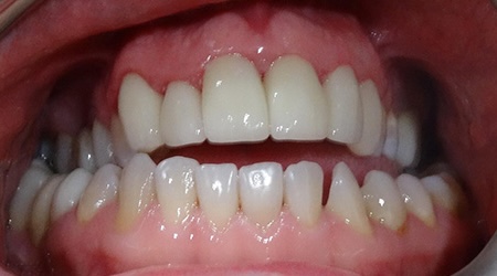 Veneers 1 after