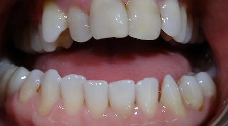 Veneers 1 before