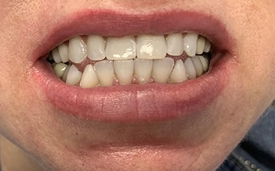 Teeth Whitening after