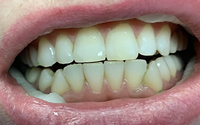 Teeth Whitening before