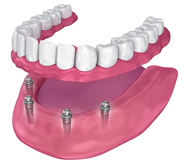 All-on-4 Implants in Manalapan, NJ