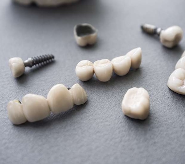 Implants vs. Mini Implants in Manalapan, NJ