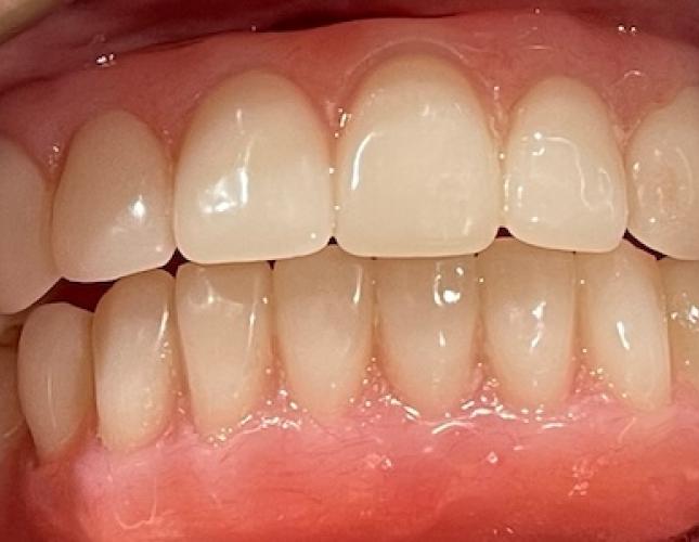 All-on-6 Implants after