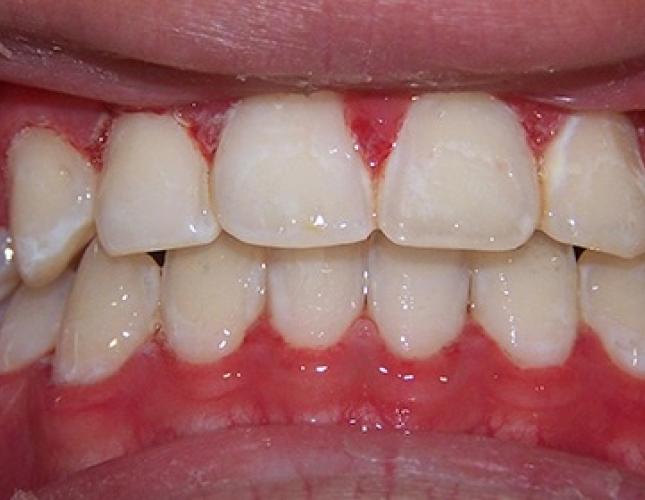 Braces 1 after