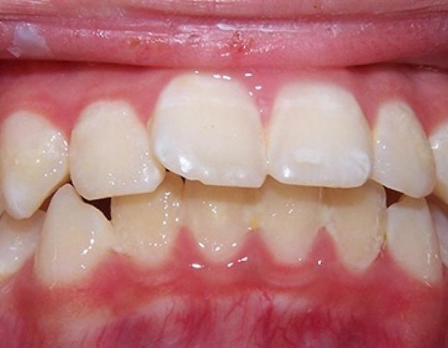 Braces 1 before