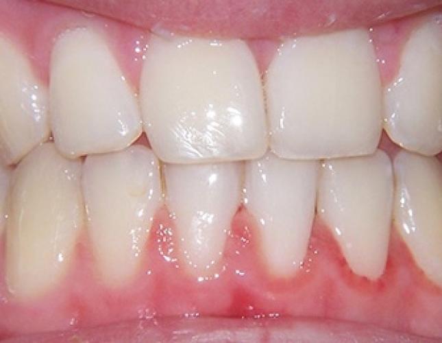 Braces 2 after