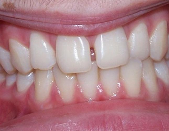 Braces 2 before