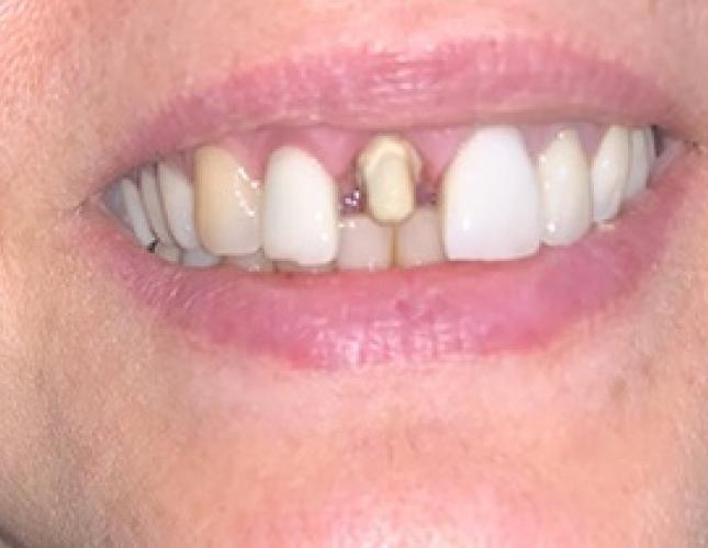 Crown before