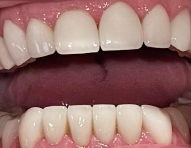 Veneers 3 after