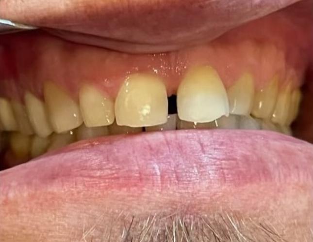 Veneers 3 before