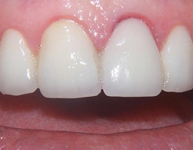 Veneers 2 after