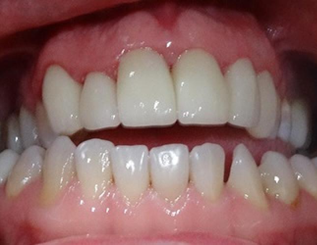 Veneers 1 after