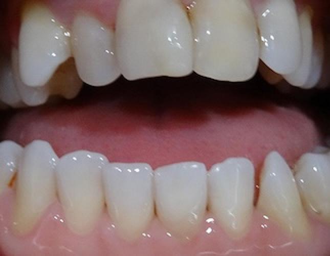 Veneers 1 before